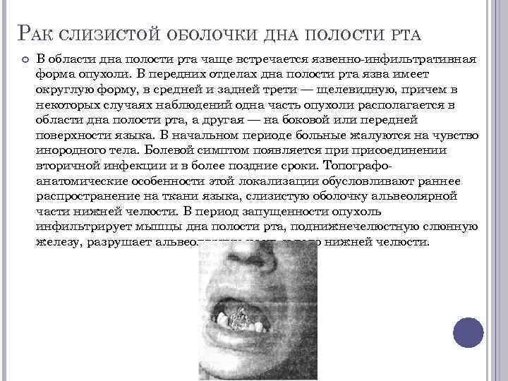 РАК СЛИЗИСТОЙ ОБОЛОЧКИ ДНА ПОЛОСТИ РТА В области дна полости рта чаще встречается язвенно-инфильтративная