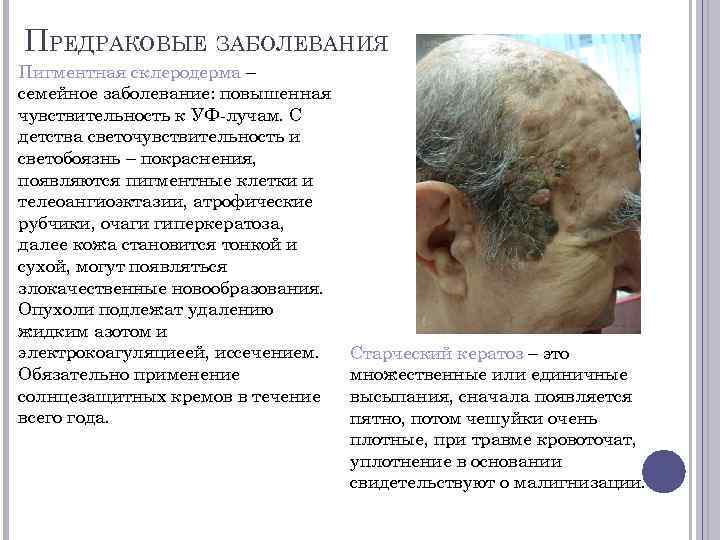 ПРЕДРАКОВЫЕ ЗАБОЛЕВАНИЯ Пигментная склеродерма – семейное заболевание: повышенная чувствительность к УФ-лучам. С детства светочувствительность