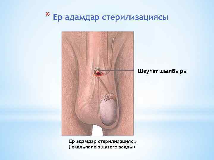 * Ер адамдар стерилизациясы Шәуһет шылбыры Ер адамдар стерилизациясы ( скальпелсіз жүзеге асады) 