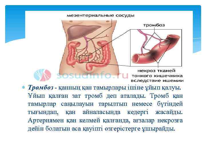  Тромбоз - қанның қан тамырлары ішіне ұйып қалуы. Ұйып қалған зат тромб деп