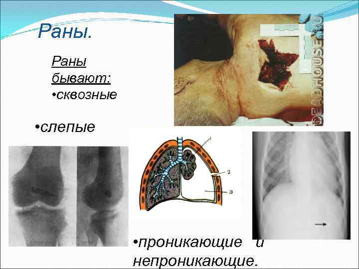 Раны бывают: • сквозные • слепые • проникающие и непроникающие. 