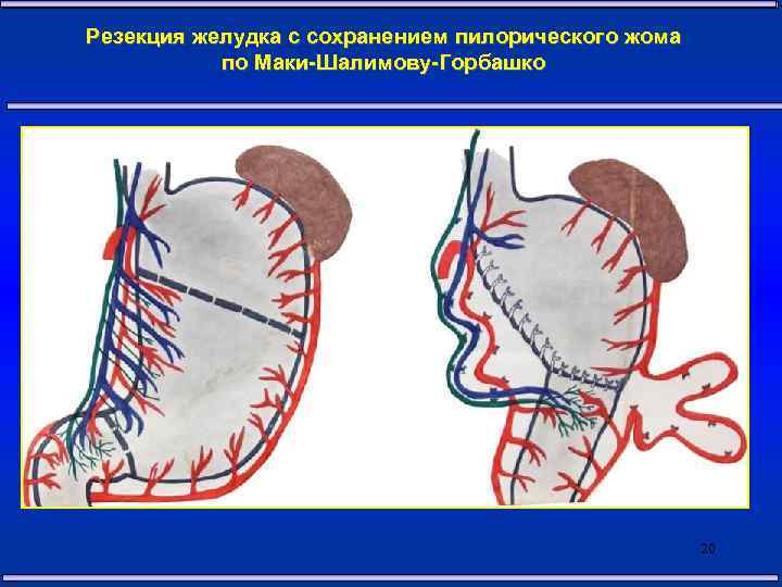 Резекция желудка по бальфуру схема