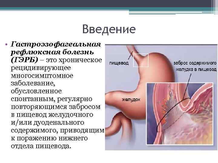 Введение • Гастроэзофагеальная рефлюксная болезнь (ГЭРБ) – это хроническое рецидивирующее многосимптомное заболевание, обусловленное спонтанным,