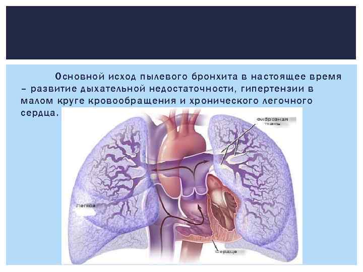 Основной исход пылевого бронхита в настоящее время – развитие дыхательной недостаточности, гипертензии в малом