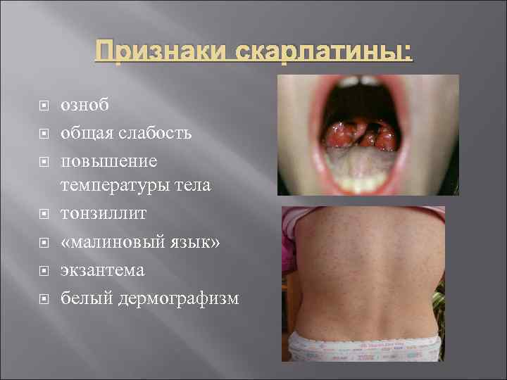 Признаки скарлатины: озноб общая слабость повышение температуры тела тонзиллит «малиновый язык» экзантема белый дермографизм