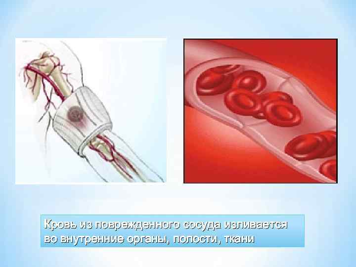 Кровь из поврежденного сосуда изливается во внутренние органы, полости, ткани 
