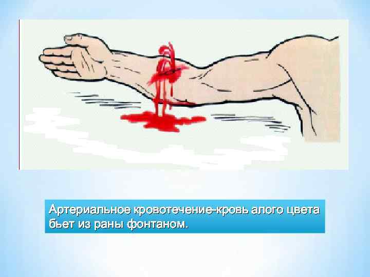 Артериальное кровотечение-кровь алого цвета бьет из раны фонтаном. 