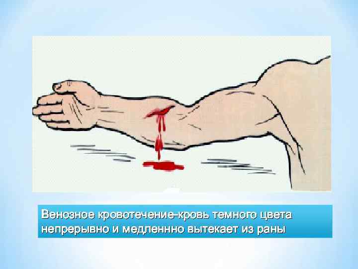 Венозное кровотечение-кровь темного цвета непрерывно и медленнно вытекает из раны 