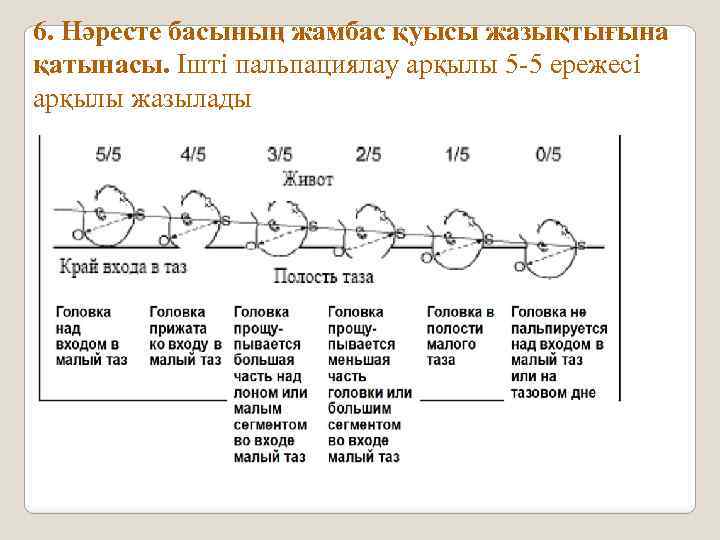 6. Нәресте басының жамбас қуысы жазықтығына қатынасы. Ішті пальпациялау арқылы 5 -5 ережесі арқылы