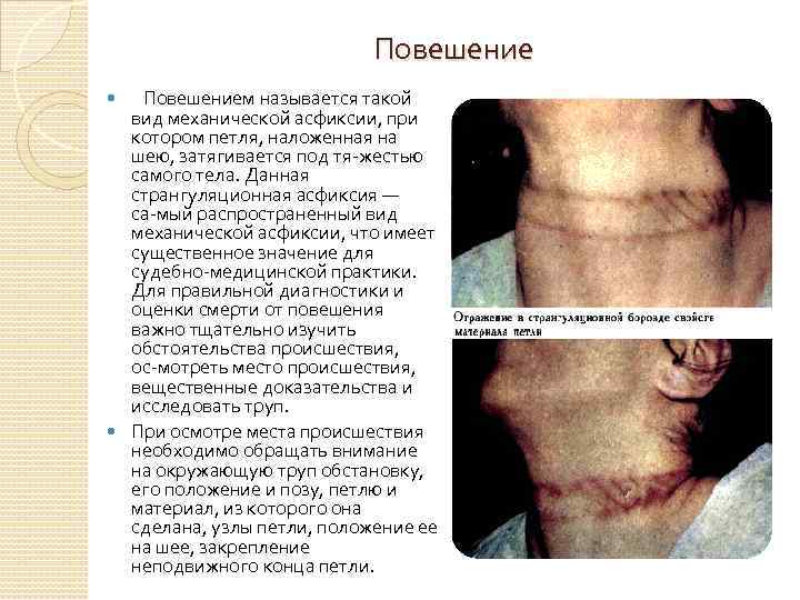 Повешение Повешением называется такой вид механической асфиксии, при котором петля, наложенная на шею, затягивается