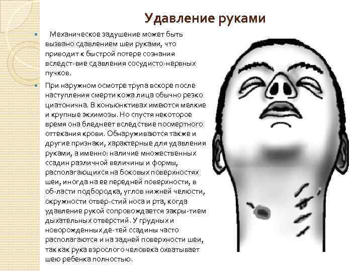Удавление руками Механическое задушение может быть вызвано сдавлением шеи руками, что приводит к быстрой