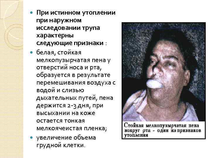 При истинном утоплении при наружном исследовании трупа характерны следующие признаки : белая, стойкая мелкопузырчатая