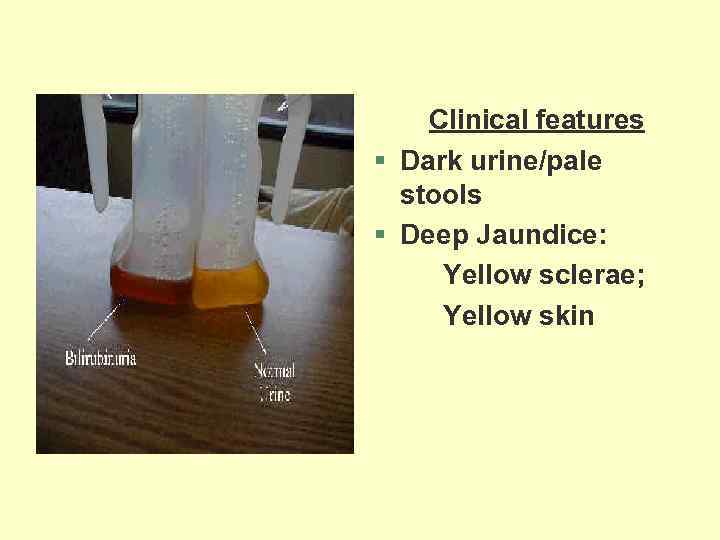 Clinical features § Dark urine/pale stools § Deep Jaundice: Yellow sclerae; Yellow skin 