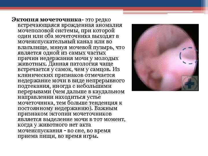 Эктопия мочеточника- это редко встречающаяся врожденная аномалия мочеполовой системы, при которой один или оба