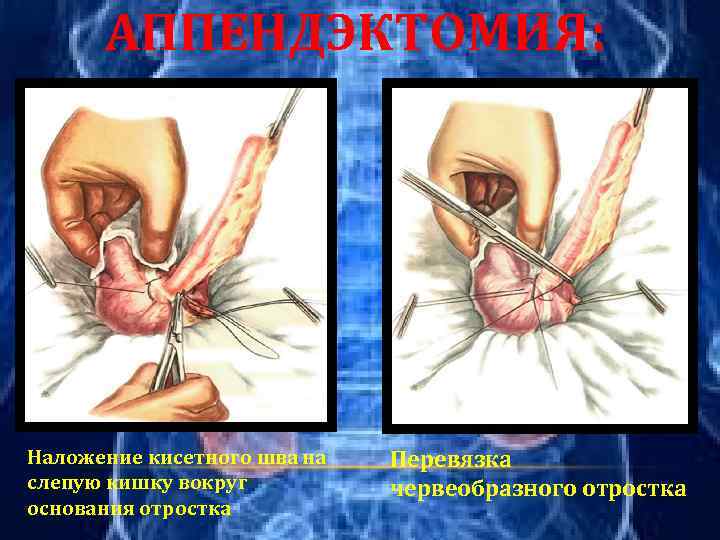 АППЕНДЭКТОМИЯ: Наложение кисетного шва на слепую кишку вокруг основания отростка Перевязка червеобразного отростка 