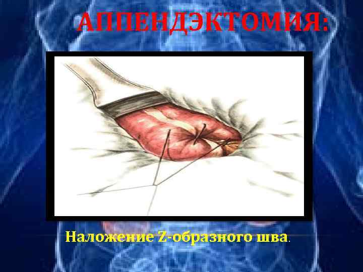 АППЕНДЭКТОМИЯ: Наложение Z-образного шва. 