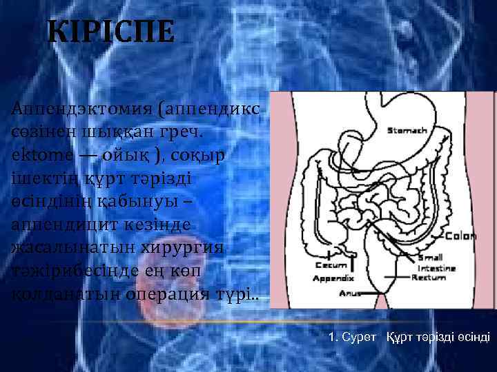КІРІСПЕ Аппендэктомия (аппендикс сөзінен шыққан греч. ektome — ойық ), соқыр ішектің құрт тәрізді