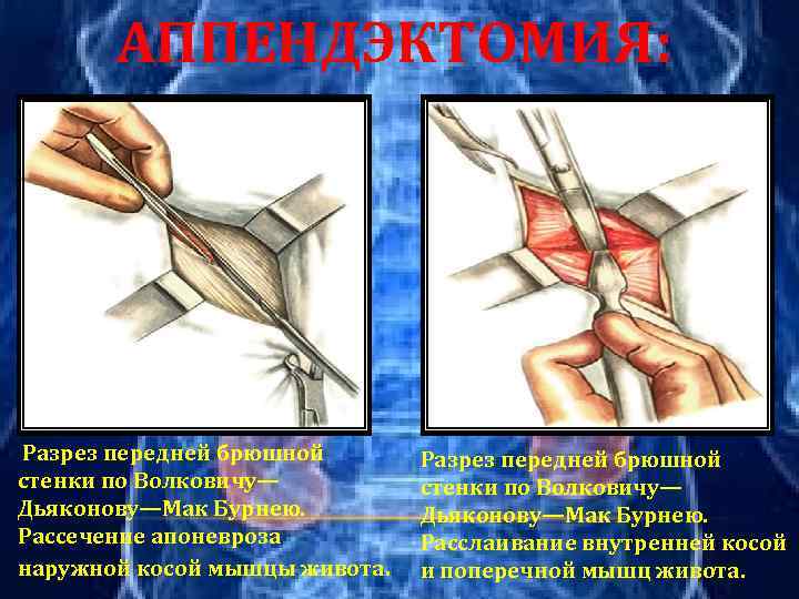 АППЕНДЭКТОМИЯ: Разрез передней брюшной стенки по Волковичу— Дьяконову—Мак Бурнею. Рассечение апоневроза наружной косой мышцы