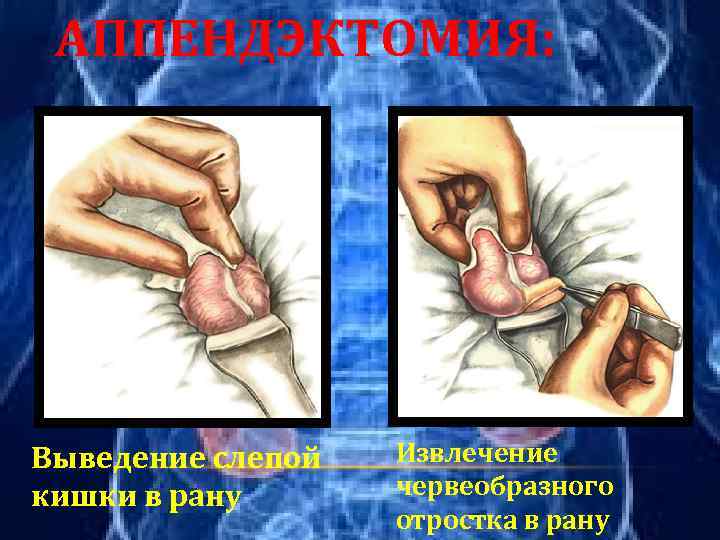 АППЕНДЭКТОМИЯ: Выведение слепой кишки в рану Извлечение червеобразного отростка в рану 