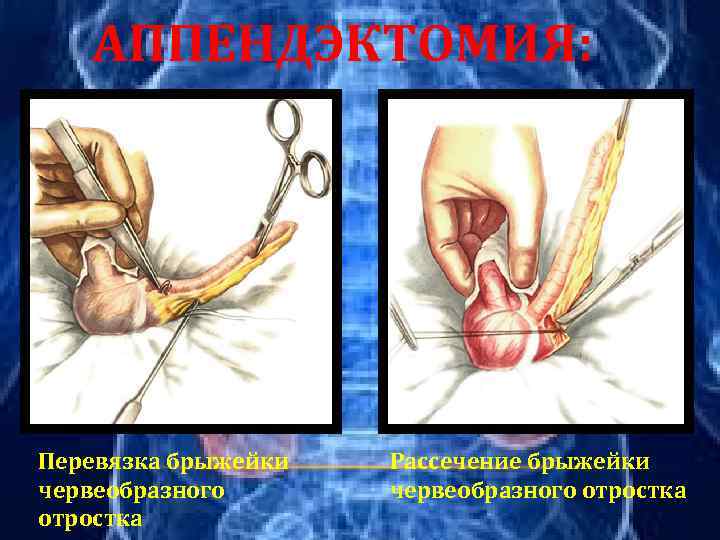 АППЕНДЭКТОМИЯ: Перевязка брыжейки червеобразного отростка Рассечение брыжейки червеобразного отростка 
