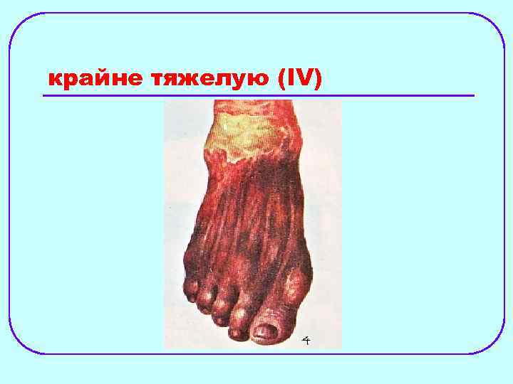 крайне тяжелую (IV) 