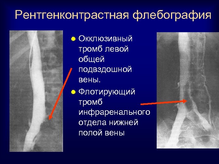 Рентгенконтрастная флебография ® Окклюзивный тромб левой общей подвздошной вены. ® Флотирующий тромб инфраренального отдела