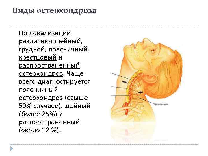 Типы остеохондроза