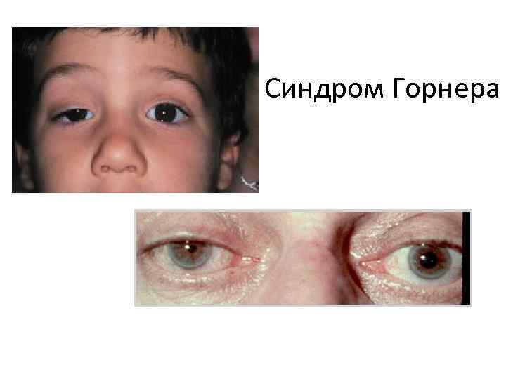 Синдром Горнера 