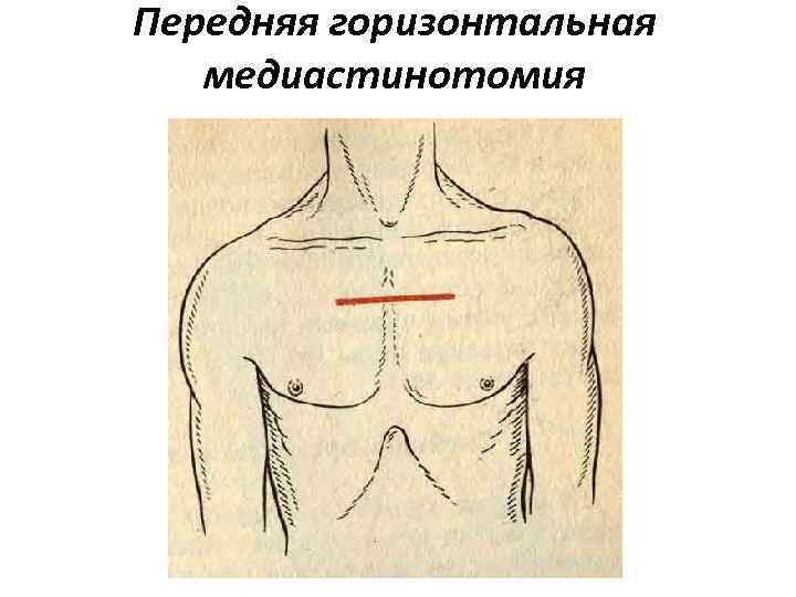Передняя горизонтальная медиастинотомия 