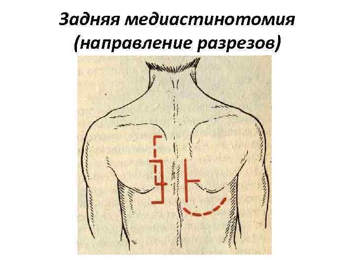 Задняя медиастинотомия (направление разрезов) 