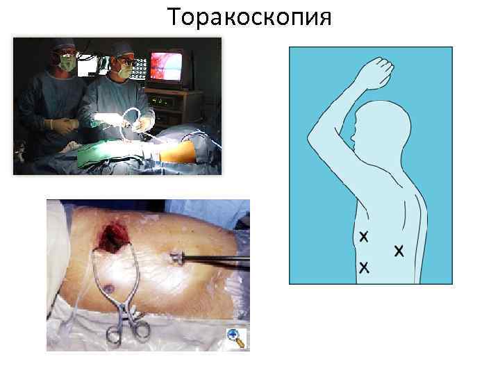 Торакоскопия 