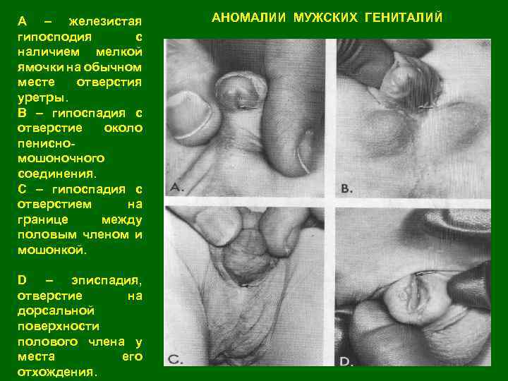 A – железистая гипосподия с наличием мелкой ямочки на обычном месте отверстия уретры. B