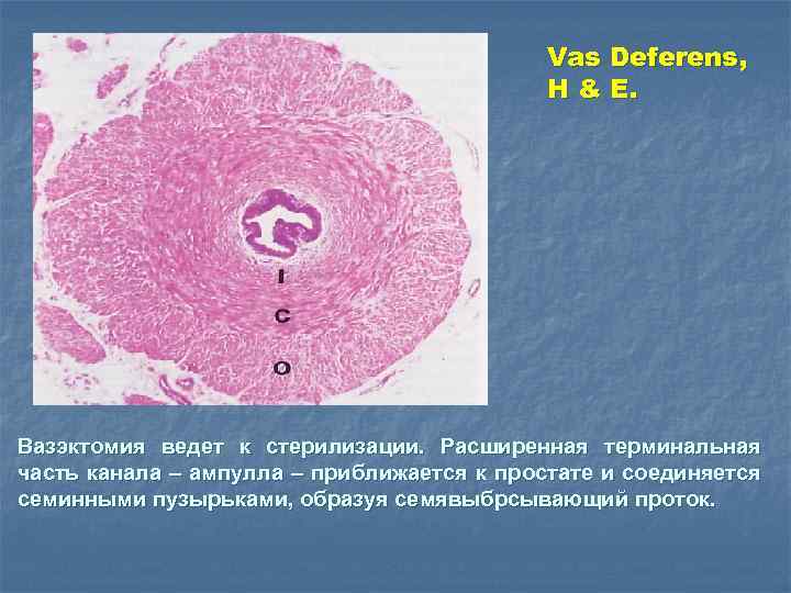 Vas Deferens, H & E. Вазэктомия ведет к стерилизации. Расширенная терминальная часть канала –