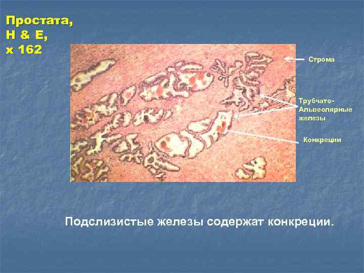 Простата, H & E, x 162 Строма Трубчато. Альвеолярные железы Конкреции Подслизистые железы содержат