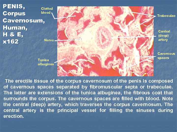 PENIS, Clotted blood Corpus Cavernosum, Human, H & E, Nerve x 162 Tunica albuginea