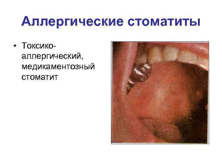 Аллергические стоматиты • Токсикоаллергический, медикаментозный стоматит 