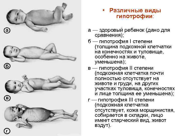  • Различные виды гипотрофии: а — здоровый ребенок (дано для сравнения); б —