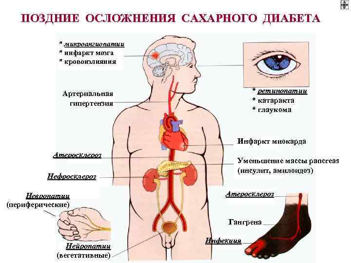 ПОЗДНИЕ ОСЛОЖНЕНИЯ САХАРНОГО ДИАБЕТА * микроангиопатии * инфаркт мозга * кровоизлияния * ретинопатии *