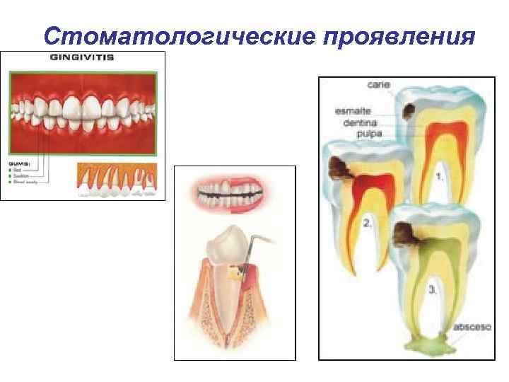 Стоматологические проявления 