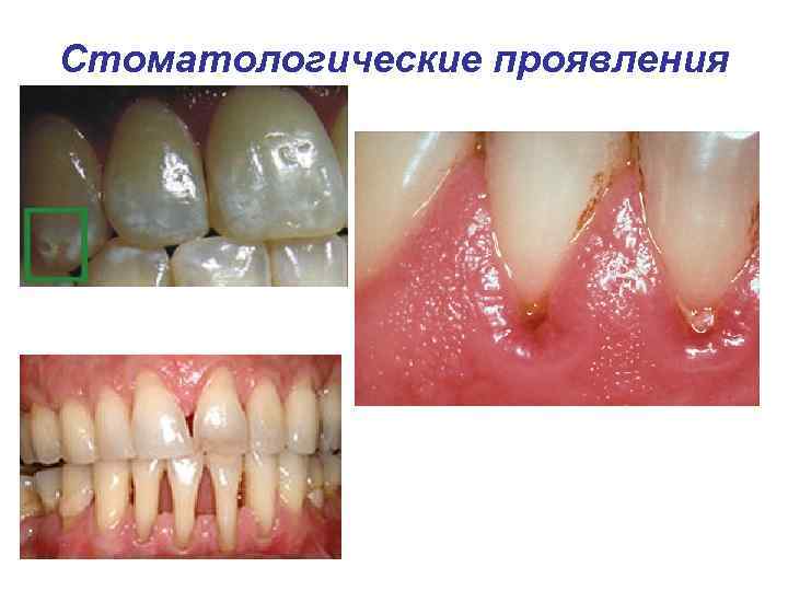 Стоматологические проявления 