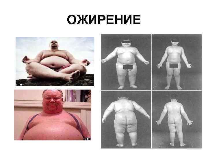 ОЖИРЕНИЕ 