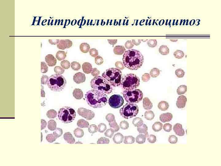 Патология крови лейкоцитозы. Нейтрофильный лейкоцитоз механизм. Что значит лейкоцитоз
