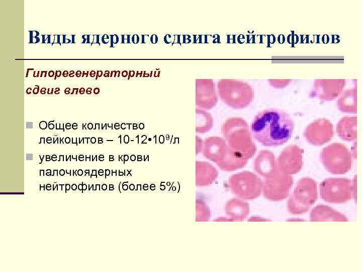 Лейкоцитоз нейтрофилез. Лейкоцитозы, лейкозы и лейкопении.. Лейкоцитоз палочкоядерный сдвиг. Лейкоцитоз с нейтрофильным сдвигом. Увеличение палочкоядерных нейтрофилов.