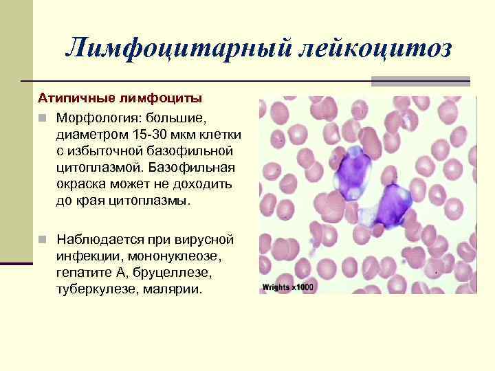 Реактивные изменения лейкоцитов. Атипичные мононуклеары микроскопия. Лейкоцитозы, лейкозы и лейкопении.. Лимфоцитарный лейкоцитоз характерен для:. Патогенез лимфоцитарного лейкоцитоза.