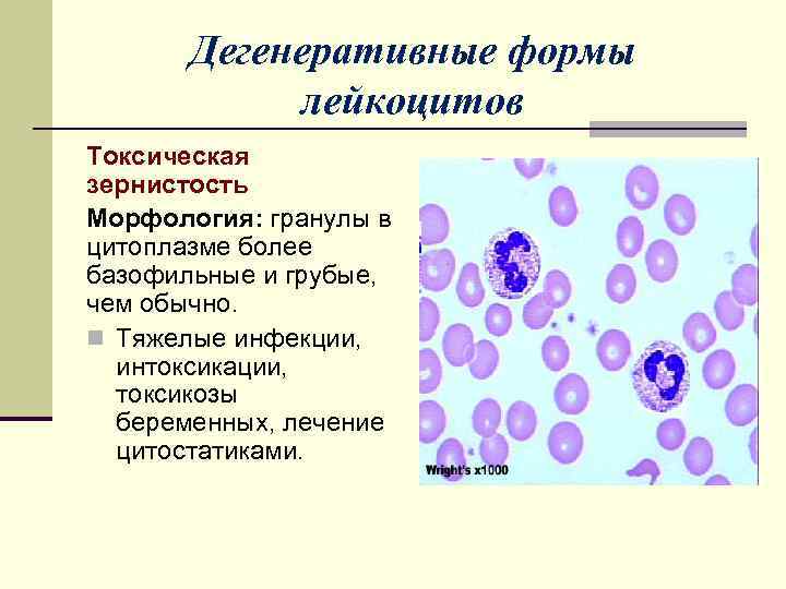 Клетка с базофильной цитоплазмой. Токсогенная зернистость нейтрофилов. Патологические формы лейкоцитов. Морфология заболеваний лейкоцитов. Цитоплазма лимфоцитов.