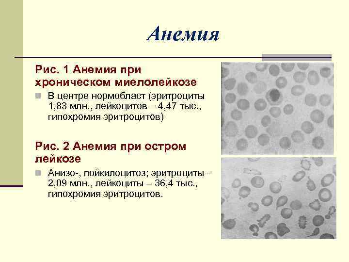Лейкопения при анемии