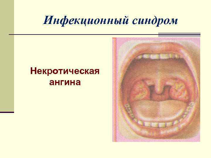 Инфекционный синдром Некротическая ангина 