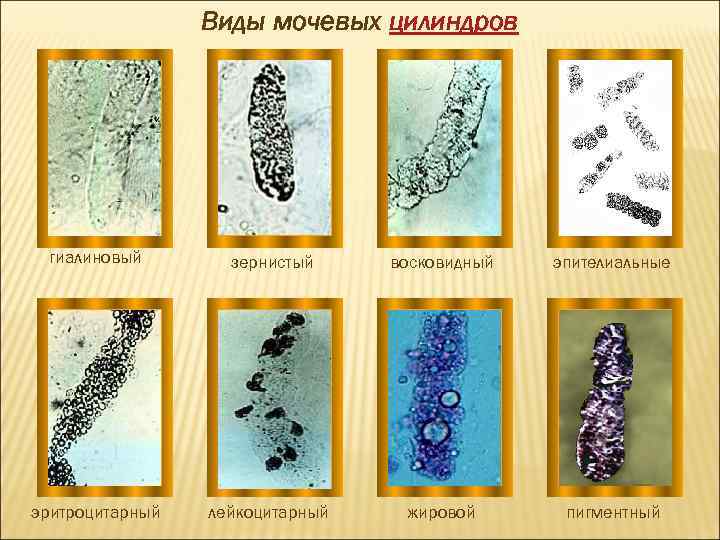 Виды мочевых цилиндров гиалиновый зернистый восковидный эпителиальные эритроцитарный лейкоцитарный жировой пигментный 