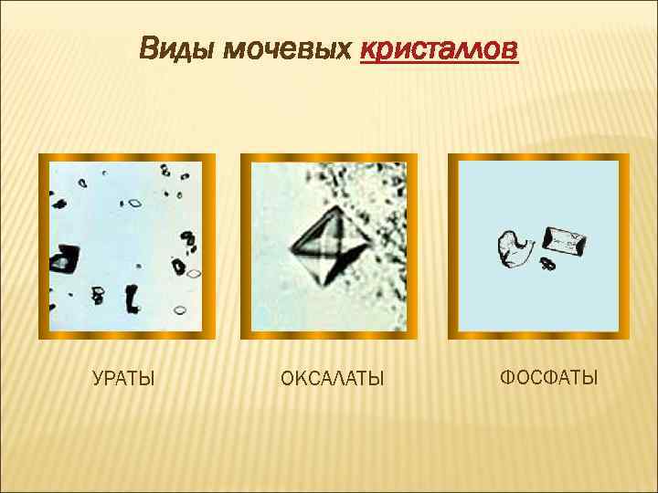 Виды мочевых кристаллов УРАТЫ ОКСАЛАТЫ ФОСФАТЫ 