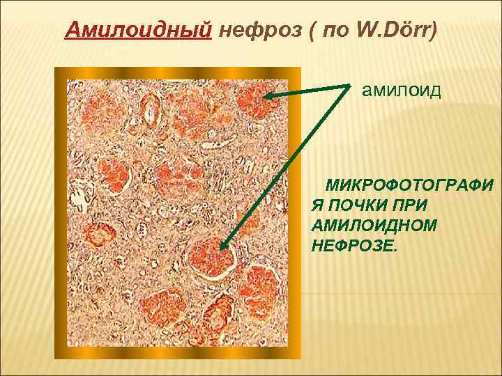 Нефроз. Амилоидный нефроз рисунок. Исходы амилоидного нефроза.